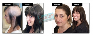 Hair Replacement in Dilsukhnagar, Hair Extensions For Women,